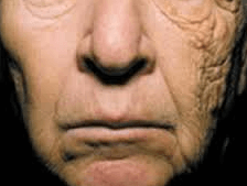 顔ダニの症状の写真　画像　老化